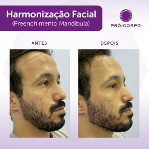 harmonização-8ml-masculina